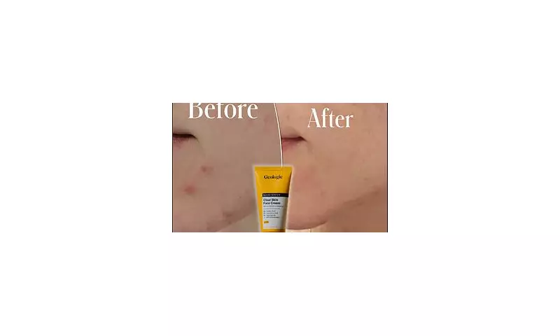 Geologie's Breakthrough Acne Serums: The Skincare Revolution You Need