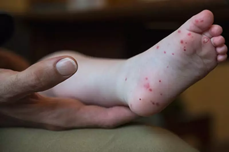 Summer Surge in Hand, Foot, and Mouth Disease: What Parents Need to Know