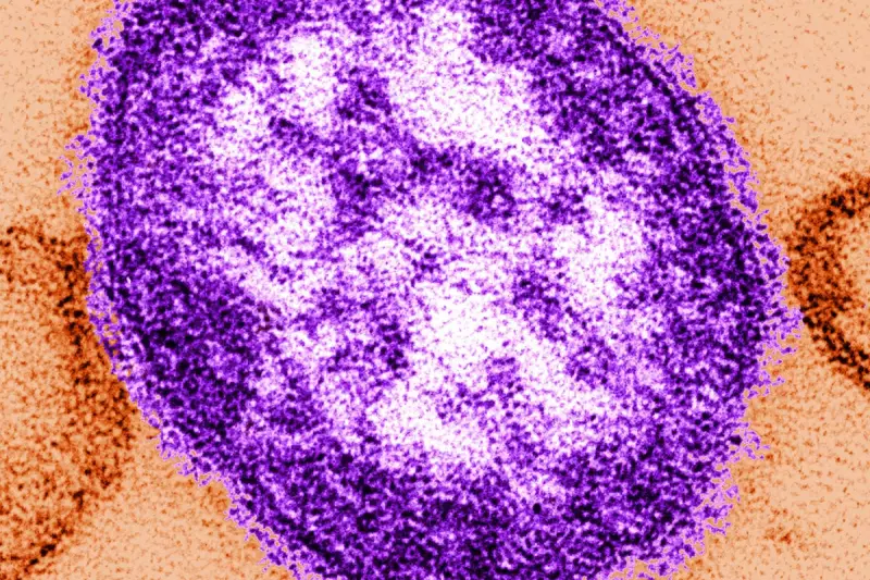 UK Measles Outbreak: First Child Death Sparks Urgent Health Warning