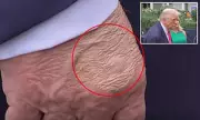 Mysterious Marks on Donald Trump's Hand Spark Health Concerns Among Experts