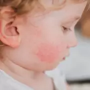 Parents' Horror as Babies Develop Blistering Skin Condition – Experts Warn of Rising Cases