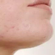 Shoppers Rave About 'Invisible' Pimple Patches That Work Overnight