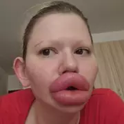 Woman With World's Biggest Lips Reveals Shocking Transformation – Before and After