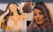 Woman's £63k Nightmare: How Bum Implants Ruined Her Life & The Painful Road to Recovery
