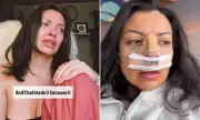 Woman's Plastic Surgery Nightmare: How a Nose Job Left Her Face 'Ruined'