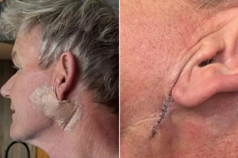Gordon Ramsay's Skin Cancer Shock: Chef's Urgent Warning After Basal Cell Carcinoma Diagnosis