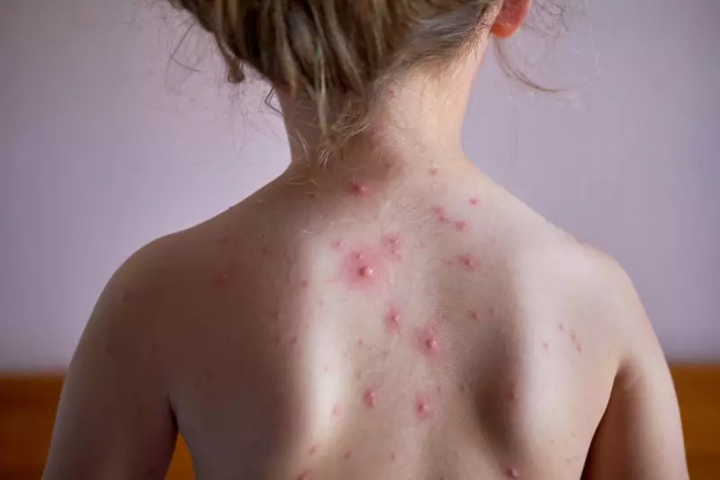 MMR and Chickenpox Vaccine Rollout: NHS to Offer Dual Jab to Children in Major Health Boost