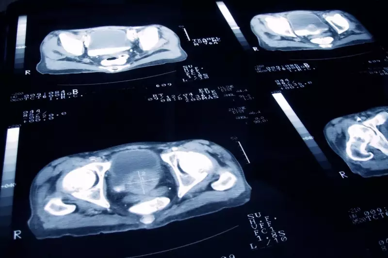 Prostate Cancer Warning: Thousands of Men May Be Receiving Unnecessary Treatment