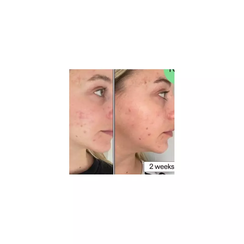 Revolutionary Anti-Blemish Serum Promises Clear Skin in Just 7 Days – Here's How It Works