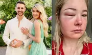 Bride Left Blind in One Eye After Pre-Wedding Beauty Treatment – Urgent Warning Issued