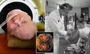 CDC Issues Urgent Travel Alert: Polio Detected in New Countries – Are You at Risk?