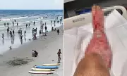 Deadly Flesh-Eating Bacteria Spreading Rapidly on UK Beaches: Cases Surge in Alarming Trend