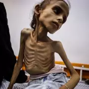Heartbreaking Image of Skeletal 9-Year-Old Girl Sparks Outrage Over Yemen Crisis