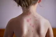 MMR and Chickenpox Vaccine Rollout: NHS to Offer Dual Jab to Children in Major Health Boost