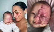 Mother Defends Controversial Laser Treatment on Baby's Birthmark – See the Stunning Results 3 Years Later