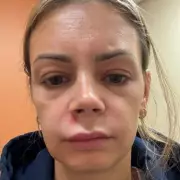 Mum Rushed to Hospital After Losing Ability to Smile – Shocking Bell's Palsy Diagnosis