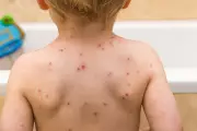 NHS Rolls Out Chickenpox Vaccine for Children in Major UK Health Milestone