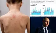 NHS Rolls Out Lifesaving Chickenpox Vaccine For All Children: What Parents Must Know