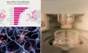 Revolutionary New Treatment Offers Hope for Debilitating Nerve Disease Affecting Millions in Their 50s