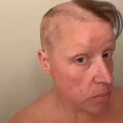 Woman's Shocking Hair-Pulling Habit Led to a Pile the Size of a Tennis Ball – The Hidden Dangers of Trichotillomania