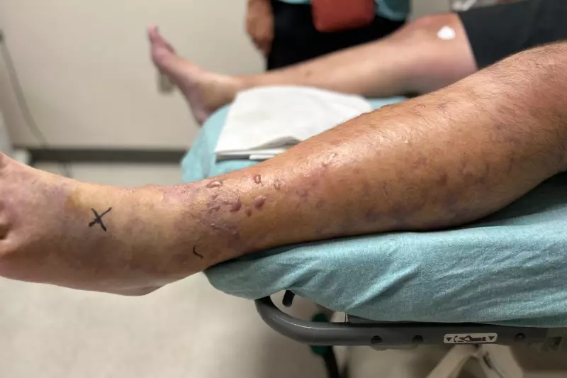 Florida Father's Fishing Trip Nightmare: Flesh-Eating Bacteria Nearly Claims His Life