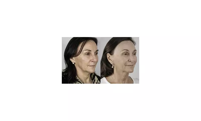 Shirley Ballas Unveils Stunning Non-Surgical Facelift Transformation Ahead of Strictly Come Dancing Return