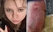 Arizona School Bus Scandal: Teen Hospitalised with Severe Burns After Being Trapped in 60°C Heat