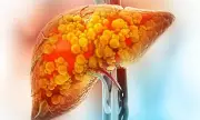 Breakthrough in Deadly Liver Disease: Scientists Discover Surprising Cause and Potential Cure for MASH