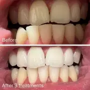 Dentist's 95p Teeth Whitening Secret: Supermarket Product Rivals £300 Treatments