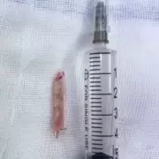 Doctors Discover 20-Year-Old Thermometer Lodged Inside Patient's Rectum in Shocking NHS Case