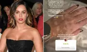 Georgia May Foote Opens Up About Vitiligo Journey: 'It's Spreading, But I'm Embracing It'