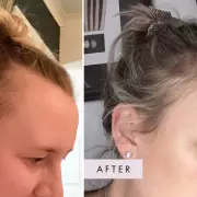 Hair Loss Nightmare: Mum's Shocking Discovery After Using Regrowth Treatment