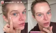Helen Flanagan Reveals Painful Facial Bruising After £500 Cosmetic Treatment | Makeup-Free Confession