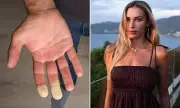 Medical Breakthrough: New Ray of Hope for Raynaud's Sufferers as Doctors Discover Revolutionary Treatment | UK Health News