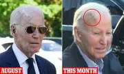 President Biden Undergoes Successful Surgery to Remove Skin Cancer Lesion