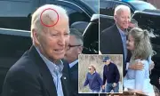 President Biden's Head Scar Sparks Health Questions: Doctors Confirm Skin Cancer Diagnosis