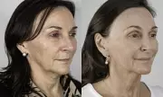Shirley Ballas Unveils Stunning Non-Surgical Facelift Transformation Ahead of Strictly Come Dancing Return
