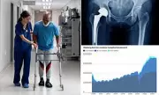 Urgent NHS Warning: Thousands of Hip Replacements at Risk of Fracture