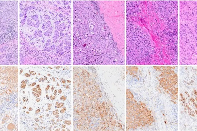 Cancer Vaccine Breakthrough: UK Trial Shows Dramatic Results for Melanoma Patients