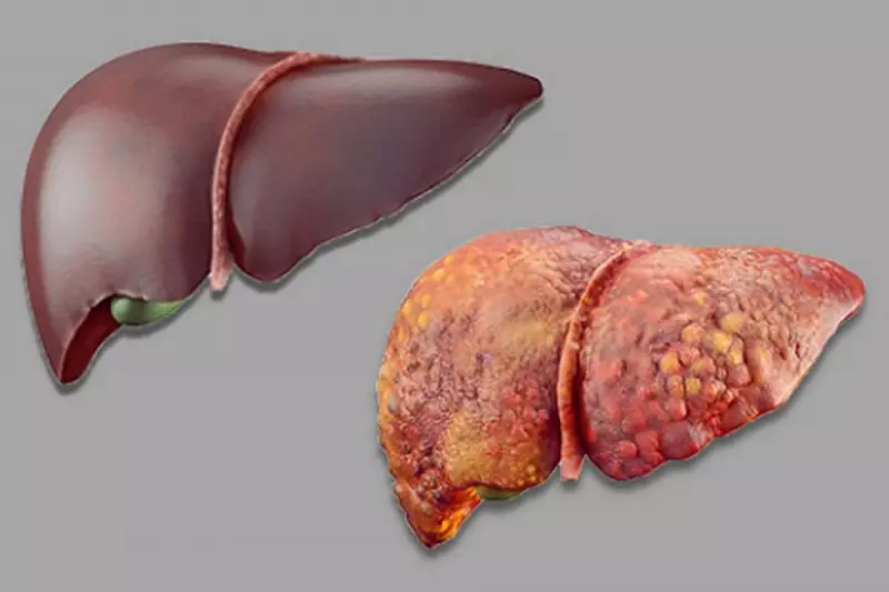 Forget Fad Diets: Common Fibre Found in These Everyday Vegetables Could Combat Fatty Liver Disease