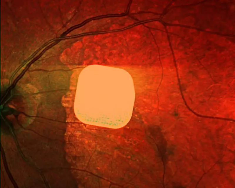 Medical Miracle: Electronic Implant Successfully Restores Sight to Blind Patients in UK Trial
