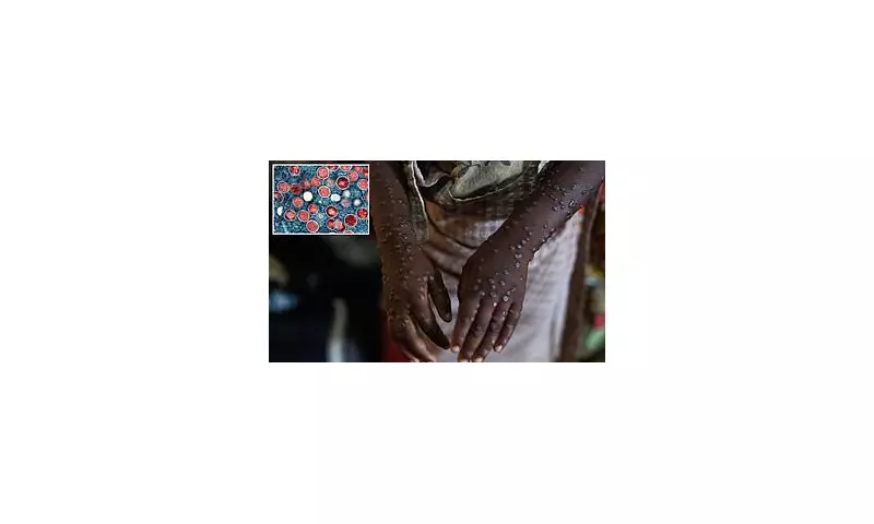 New Mpox Strain Detected in Los Angeles: Health Authorities Issue Urgent Warning