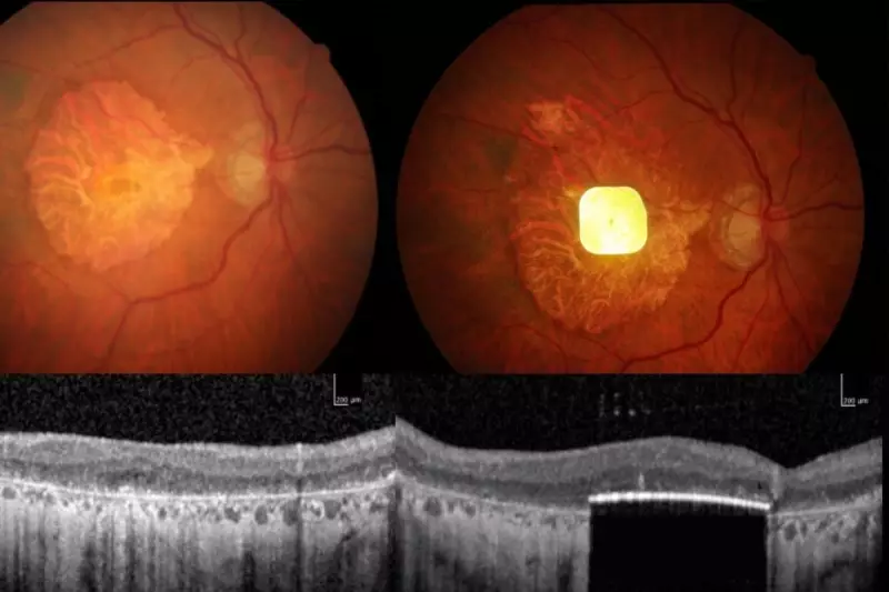 Revolutionary Eye Surgery Breakthrough: London Surgeons Transform AMD Treatment