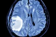Beyond the Headache: The Hidden Signs of Brain Tumours You Should Never Ignore