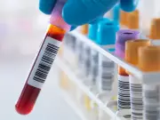 Breakthrough Blood Test for Chronic Fatigue Syndrome Offers First-Ever Diagnostic Hope for Millions