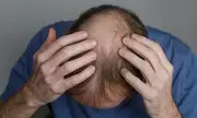 Breakthrough in Hair Loss Treatment: New Therapy Shows Remarkable Regrowth Potential