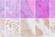 Cancer Vaccine Breakthrough: UK Trial Shows Dramatic Results for Melanoma Patients