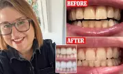 Dentist-Developed Whitening Strips Put To The Test: Our Honest Two-Week Verdict