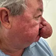 Devoted Husband's Agony After Rare Medical Condition Robs Him of Ability to Kiss His Wife