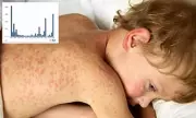 Measles Outbreak Sparks Campus Quarantine: South Carolina Students Isolated as Virus Spreads Among Unvaccinated